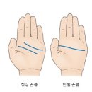 스미스 마제니스 증후근 이미지