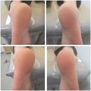 습진·무좀·진균 감염, 문제성 발 전문 관리 전후 발각질,패디플래닝,광주 서구 화정동 바르다네일