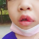6세아이구내염😬