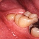 예가치과의원 | 태평역 사랑니 발치 주변은 다 쉽게 뽑았다는 데, 나는 오래 걸리는 이유?