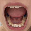 줄포S치과의원 | 건대 성인교정치과 발품, 성인 교정 후기 -2(치아모양 많음.. 주의해주세요~~) 건대 바르다 치과 내돈내산