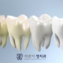 삼화치과의원 | 중계동치아미백, 미백치약이나 패치, 정말 효과 있을까요? 안전할까요?