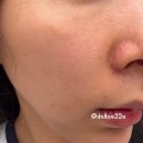 고고스킨 | 마곡레티젠 리쥬란하러갔다 받고옴 스킨부스터 내돈내산 후기
