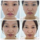 소닉테크 | 뷰티디바이스 3주 후기 듀얼소닉 글림빛 4종 비교 네모 세모 원 마름모