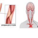 말초혈관질환이란? 이미지