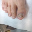 홈플러스(주) 금천점 | 구로 관악구 발톱무좀 관리 직후 아픈게 줄어드는 오벨리네일푸스 족보있는그녀들 금천점 후기