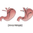 "호르몬 대체요법, 위-식도 역류 질환 위험↑" 이미지