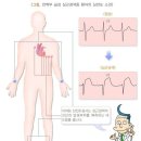 허혈성심장질환 진단비(감액없음) 특별약관 이미지