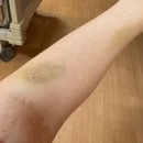 봄빛약국 | 봄빛병원 제왕절개 수술 출산 입원 후기 1편