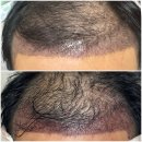 3400 | 내돈내산 대구 남자 비절개 3400모 모발이식 후기 (당일~ 일주일)