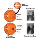 무서운 안질환 황반변성 진단 및 치료 &저시력도구의 사용방법 ​ 이미지