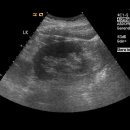 초음파 검사 사진, 이 정도이면 어떤 상태인가요 이미지