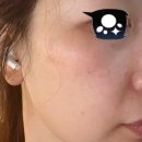 압구정 라움성형외과 흑자제거 2년경과 리뷰...현재 피부는 어떨까?