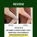 슬림영의원 | 송파팔뚝사후관리ㅣ송파 지흡러가 선택한 사후관리! 단 3회 만에 팔뚝 뭉침 풀고 슬림핏👍