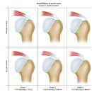 K Implant(케이 임플란트) | Regeneten (리제네텐)-회전근개 부분파열 : 봉합을 꼭 해야할까?