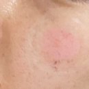 뉴브의원 | 강남/용인 흑자, 주근깨 완벽제거 1년 후기 (리팟레이저, 루비레이저 내돈내산)