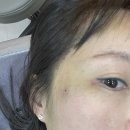 한국GM칠곡바로서비스 | 대구칠곡흑자제거 피코레이저 후기 (전후사진 포함)