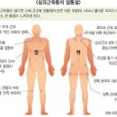 섬유근육통 원인 이미지