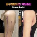 탑라인의원 | 압구정탑라인의원 팔뚝지방흡입 후기 일자 라인 만들기