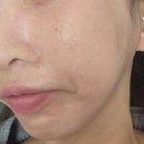 부천 중상동 유도짐 | 경기도 부천 피부과에서 요즘 핫한 셀르디엠 스킨부스터 후기 +효과 통증 전후비교