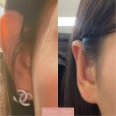 돌출귀 수술 후기, 회복기간, 잘하는 병원 고르는 팁