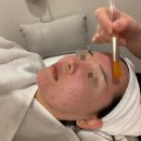 늘,파인 | 여드름파인흉터 자국 치료 강남피부과 쥬베룩 레이저가격 후기