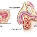 고환 통증 원인 고환암 부고환염 고환염전 증상 이미지