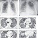 급성 폐장염[acute interstitial pneumonia, AIP] 이미지