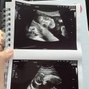 춘천태동요양병원 | 임신 18주~20주 21주 태동 증상 및 정밀초음파 태교여행 예약 경부길이