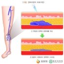 외모개선 목적의 다리정맥류 수술[2016년 1월 1일 이전 실손의료비보험 약관] 이미지