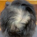 항암치료후 넓은탈모부위와 극손상모발 탈모교정성형펌과두피케어손상모발복구케어로나 다시돌아간다! 부산사상구 괘법동 르네시떼6층 미용실 이미지