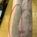 서울미라클피부과의원 | [광주 피부과]미라클의원🏥문신•타투제거 생생후기•4차 시술 지옥의불맛 경험하다🔥🔥