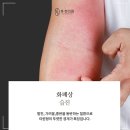 습진 치료 시 "연고 바르면 낫겠지"라는 생각이 만성을 일으킵니다 (춘천 한의원)
