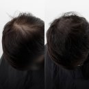 라이모플러스(LYMOPLUS) | 마곡두피 마곡·발산의 라이모플러스에서 커버 시술 후기