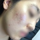 명현 | [이소티논 1주차] 명현현상 부작용 효과 솔직 후기