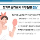 꽃가루 알레르기 피부의 고통을 완하시키는 방법 이미지