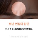 창조피부과의원 | 당신의 미간 주름 타입은? 울산 피부과 미간 주름 관리법