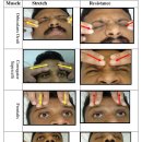 FACIAL NERVE PARALYSIS. 구안와사 치료법 이미지