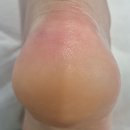 메디프라자 | 한 달에 한 번 꼭 받는 각질관리, 본네일 동성제약 풀리메디 문제성 발관리 후기 👣