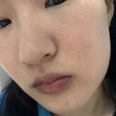 한의원에서 피부시술?/색소침착시술후기/내돈내산/시술장단점/영등포한의원/시술 후 변화 과정