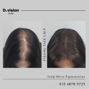 디비전 스칼프 | 탈모 치료를 받을 때 어떤 것들을 조심해야 할까?