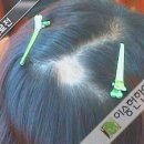 이승헌한의원 | [울산탈모치료한의원 이승헌한의원] 울산한방탈모치료후기 - 탈모치료 후 잔머리가 많이 났어요