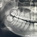 270-1105 | 매복사랑니 발치 후기_1~7일차🦷💉 (신경을 누르던 사랑니🥺)