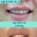 [명동 한번에 치과] 입술 비대칭과 거미스마일 동시 해결! 레이저 구강전정술+골삭제 치료 후기