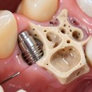 신세계경치과의원 | 이 치아, 방치하면 뼈도 못 추스른다고? 나를 위한 플랜 B를 찾아서