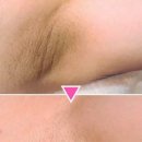 진한약국 | 약국 착색크림 팔꿈치 겨드랑이 색소침착 1개월 관리 후기