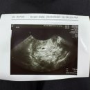 임신기록/ 4-5주차 증상공유 초기 피검사 초음파