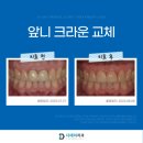 디메넥스 치과기공소 | 앞니크라운과 라미네이트 차이점은? (feat. 치료비용공개)