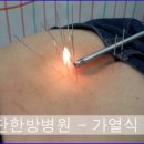 가열식 화침치료와 인대손상치료 이미지