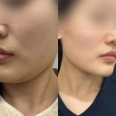 원장안 | 대전 예비신부 찐만족한 올타이트리프팅 후기 feat.키닥터원장님